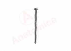 Solid Threaded Spongy Bone Screw for Bone Fracture Fixation