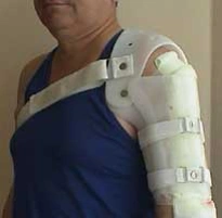 Orthopedic Device for Shoulder Joint Support