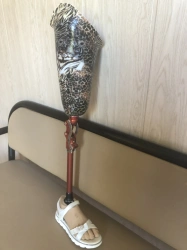 Modular Hip Prosthesis for Congenital Underdevelopment