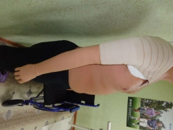 Functional-Cosmetic Prosthesis for Shoulder Disarticulation PR8-KOB