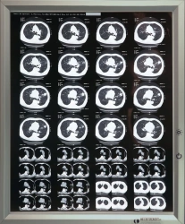 Medical Single-Frame Negatoscope with Accessories TU 9452-001-11349579-2016
